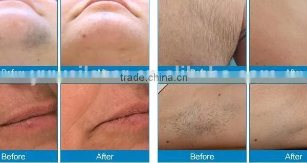 Professional Shr Ipl Hair Removal System Machine in Hot Sale photo-5