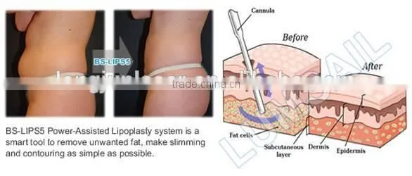 Surgical Liposuction PAL Liposuction With Liposuction Cannulas photo-5