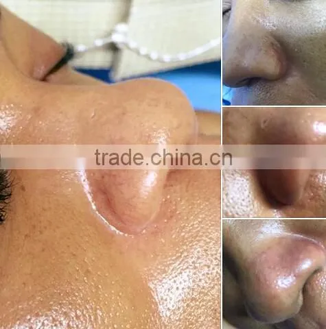 High Frequency  HIFU-C New Tech! HIFU Forehead Wrinkle Removal For Face Body Slimming Machine/liposunic Ultrasound Machine/cellulite photo-2