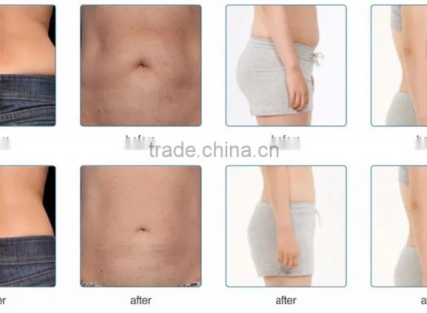 Best Selling Products 2016 Cool Tech Fat Freezing Slimming Machine photo-6