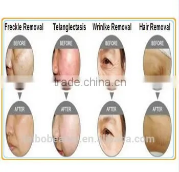 IPL Laser Longhair Short Hair Permanent Removal Beauty Equipment Aesthetic Alexandrite photo-6