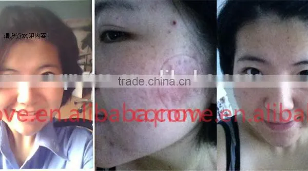 2016 Blood Vessels Removal New Product Skin Care Led Facial Light Machine Oem Biofeedback LED Mask photo-6