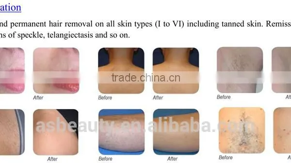 2016 High Technology 808 Laser Hair Removal Machine Portable photo-4