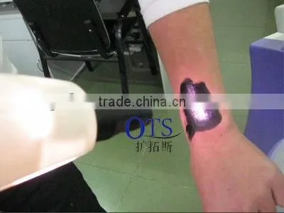 2015 Recently Designed Q-Switched ND Yag Laser for Tattoo Removal, Pigement Removal and Skin Rejuvenation photo-2
