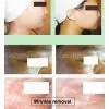 RF--radio Frequance ,anti Aging, Facelife,wrinkles Removal photo-3