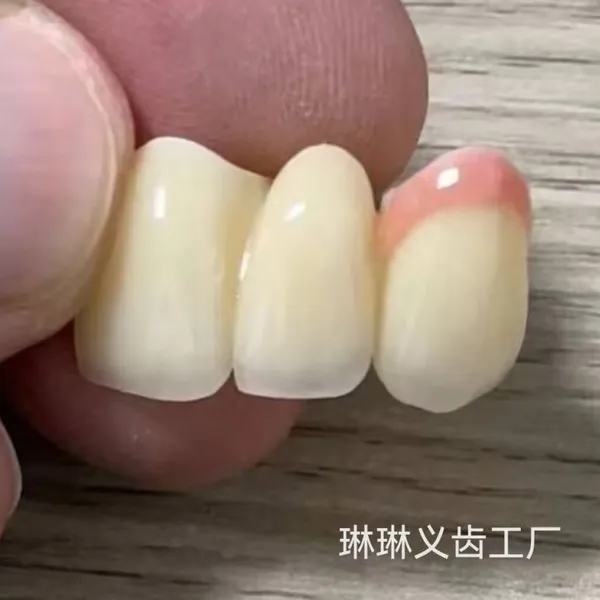 The Telescopic Crown Precision Attachment Denture Has Strong Stability photo-3