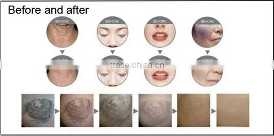 Professional Nd:yag Laser Tattoo Removal Device for Sale photo-3