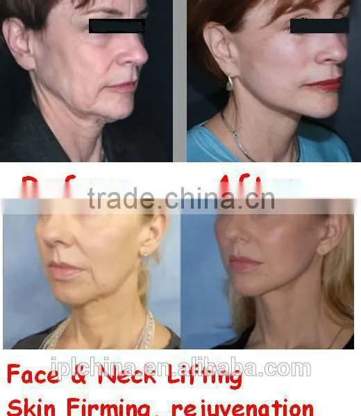 Hot Sale New Skin Beauty Microcurrent and Ultrasonic Facial Pixel rf Dermabrasion Salon Machine photo-6