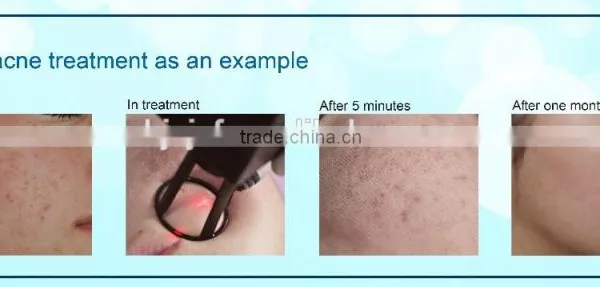 F5 Best Selling 30W RF Tube Wrinkle Removal Laser CO2 Fractional photo-5