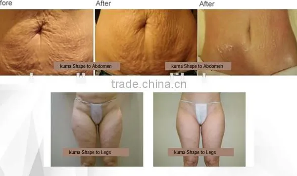 High Quality! Velashape Cavitation Negative Vacuum rf Roller Laser Clinical Equipment Ultrasonic Liposuction Belly Fat Removal photo-6