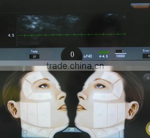 High Intensity Focus Ultrasound HIFU for Face and Neck Lift Without Surgery photo-2