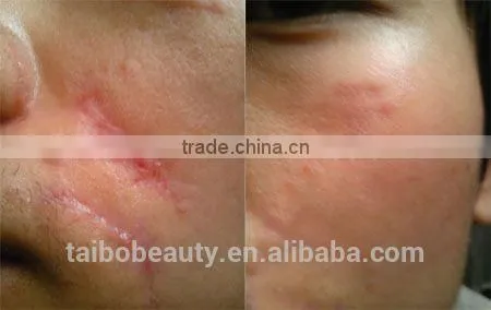 FDA Approved Beauty Equipment Scanning Co2 Fractional Laser Fractional CO2 Clean Laser Portable photo-6