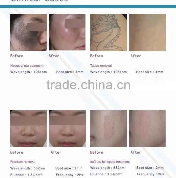 Q Switch ND YAG Laser For Colorized Tattoo Removal & 0.5HZ Pigmentation Removal/ Best Laser Tattoo Removal Machine Vascular Tumours Treatment photo-4