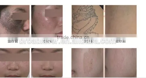 1064nm 1064 Nm 532 Nm Nd Yag 1 HZ Laser Alexandrite Laser Hair Removal Machine Price photo-5