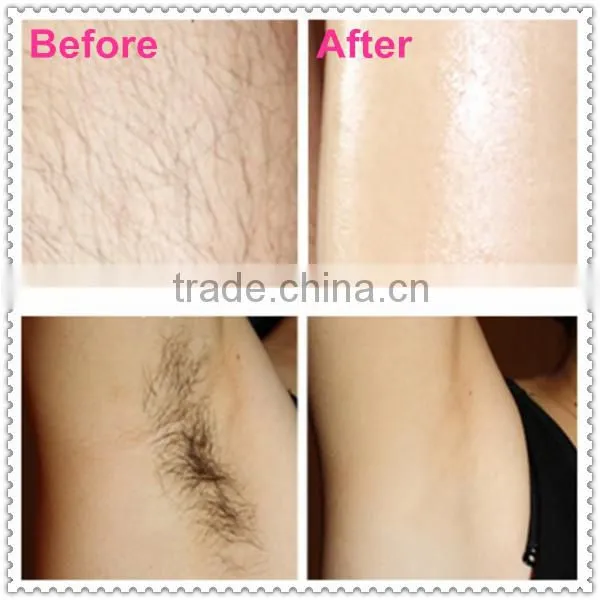 Professional Shr Ipl Hair Removal Machine photo-5