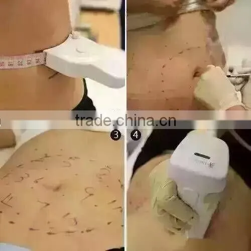 Professional High Frequency Machine Liposonix Hifu Machine Hips Shaping / Hifu Slimming Machine High Frequency Facial Device photo-6