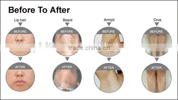 2016 Medical CE Approved Ipl, Ipl Home Laser Pigmentation, Home Ipl photo-2