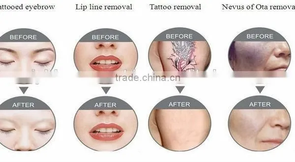 Q Switch Laser Machine Q-switched Nd Yag Laser Mole Removal Machine/ Tattoo 800mj Removal Laser Machine Nd Yag Laser/Laser Tattoo Removal Machine Haemangioma Treatment 532nm photo-2