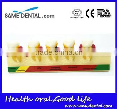 2x Periodontal Disease Classification Models Dental Eduction Assistant No. DEA-20 photo-2
