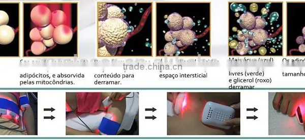 SUS Portable Lipo Diode Laser Slimming Diode Laser Medical Laser Sliming photo-2