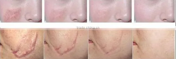 2015 Lowest Distributor Price: Sanhe Supercritical Co2 Extraction Machine for Acne Scars Treatment , Burn Debridement photo-6