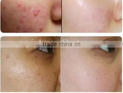 Stretch Mark Removal Acne Scar Removal Laser Laser CO2 Resurfacing Machine From With CE RF Portable Design Fractional Co2 Laser Machine Producers Tumour Removal photo-2