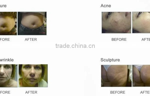 Apolomed RF Wrinkle Removal Skin Lift Beauty Equipment photo-5
