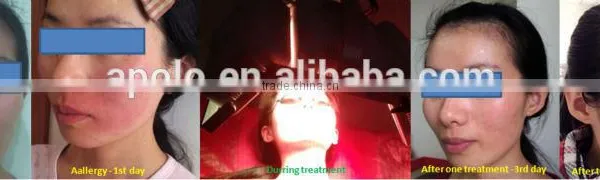 Facial Led Light Therapy High Power Acne Removal Phototherapy PDT Machine Led Light For Skin Care photo-3