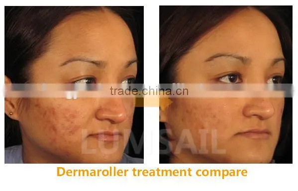 Dermaroller Derma Roller Medical Derma Roller Micro Needle Dermaroller for Salon Use photo-6