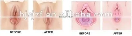 Eye Wrinkle / Bag Removal Popular Model F7+ Vaginal Fractional Rf Skin Resurfacing Co2 Fractional Laser Vaginal Tighten Machine photo-6