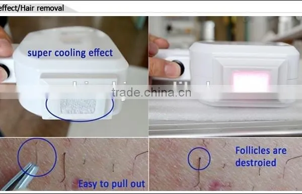 Hot Sale !!! Permanent Hair Removal Device/portable 808nm Diode Laser Device photo-5