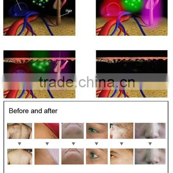 Ipl Laser Machine for Hair Loss photo-3