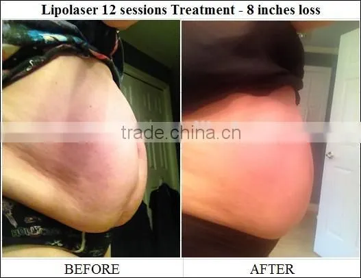 SUS 650nm Lipo Laser Fat Removal Machine/ Laser Slimming Machine photo-6