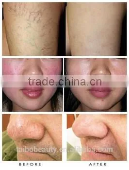 2016 The Professional Portable Varicose Veins Removal 980nm Laser Vascular Removal Beauty Equipment photo-6