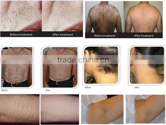 Hottest Germany Device 808 Diode / Personal Hair Removal Laser System photo-4