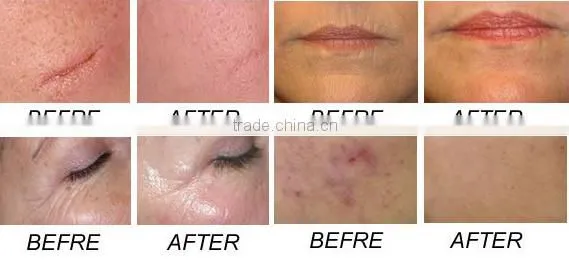 Hori Naevus Removal Best Tattoo Removal Laser Machine/ Q Switch Varicose Veins Treatment Nd Yag Laser Hair And Tattoo Removal Machine/cheap Tattoo Removal photo-6