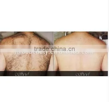 New 2016 Mini Ipl Laser Hair Removal Machine Skin Rejuvenation Beauty Equipment Supplier photo-6