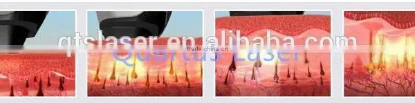 Excellent Alexandrite Laser /755 Hair Removal / Skin Refreshment Alex Laser Device photo-2