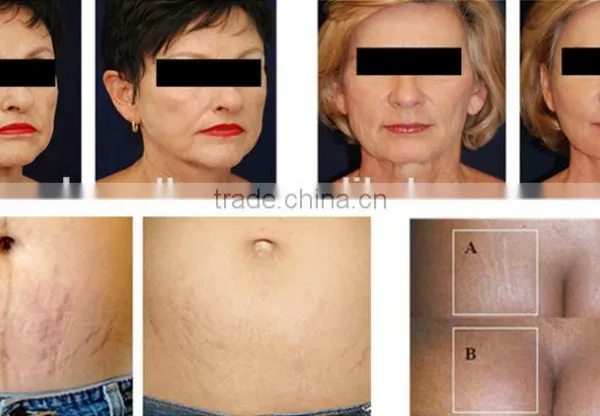 6 in 1 Lipo Ultrasonic Cavitation Machine , RF 940nm Vacuum rf Device photo-6