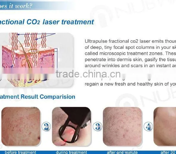 Professional Warts Removal 2016 Medical Co2 Skin Therapy Ultra Pulse Equipment Fractional Co2 Laser/vaginal Rejuvenator Laser Skin Tightening photo-3