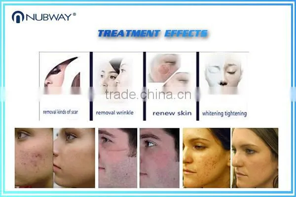 Hottest !!!!!! High Power 40W Wrinkles Removal Skin Treatment Co2 Fractional Laser for Sale photo-4