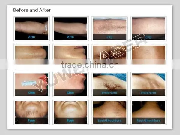 Best Price Salon Use Diode Laser Hair Removal Machine Price photo-5