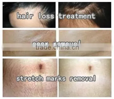 Microneedle Derma Roller Mts System 540 Microneedle Titanium photo-6