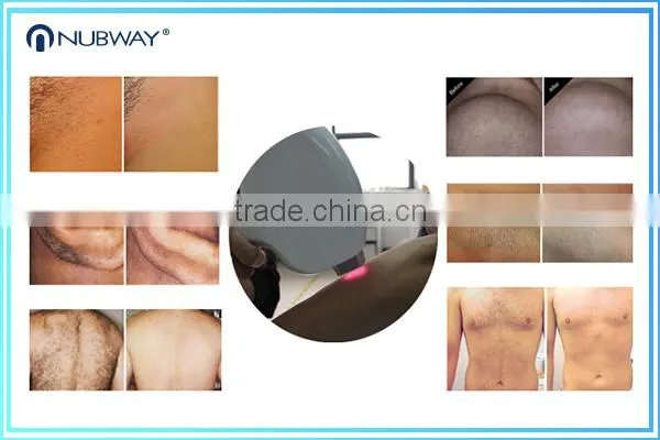 Whole Body Diode Professional Laser Hair Removal Manufacturer photo-4