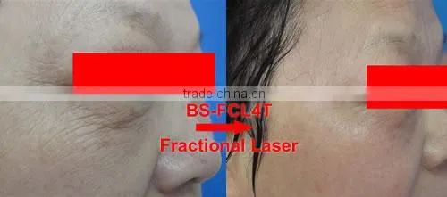 Skin Regeneration Beauty Fractional CO2 Laser Equipment 8.0 Inch 100um-2000um Fractional Laser Skin Treatment Machine Skin Renewing photo-6