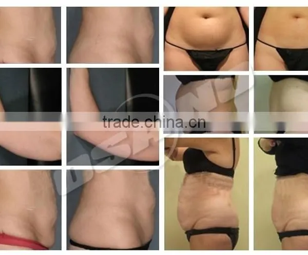 220 / 110V Freezing Pads Cryolipolysis Crypolysis Fat Freezing Machine Vertical photo-4