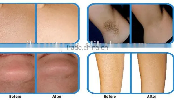 1-50J/cm2 Best Shr IPL/OPT/AFT Hair Chest Hair Removal Removal Device With Best Price Remove Diseased Telangiectasis photo-6