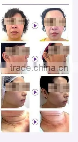 Reduction of Wrinkle, Dark Color, Puffy Skin Remage Device photo-4