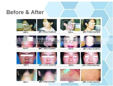 Fractional Laser Co2 Scar Removal/laser Co2 Fractional photo-5