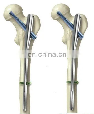 Orthopedic Trauma Implants PFNA photo-3